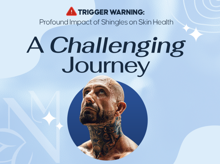 Man with visible skin effects representing shingles impact on skin health and healing.