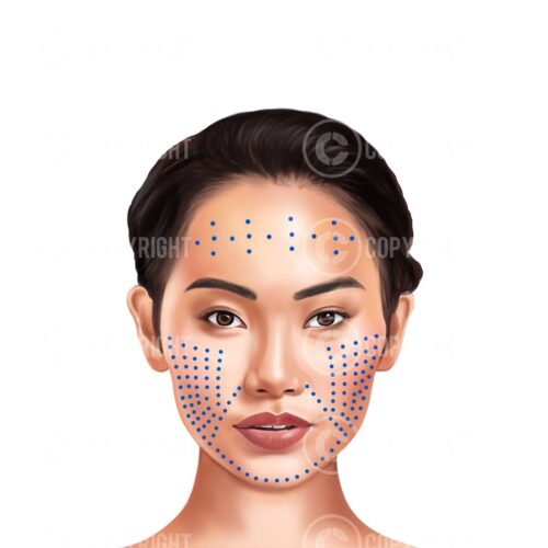 Mesotherapy Nappage Injection Pattern Bundle Sakura Digital Download