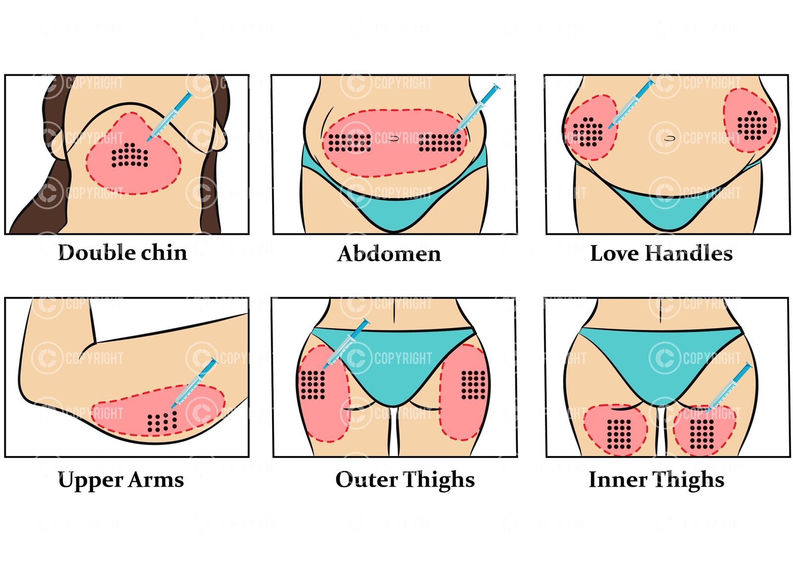 Fat Dissolving Injection Pattern | Aqualyx | Digital Download