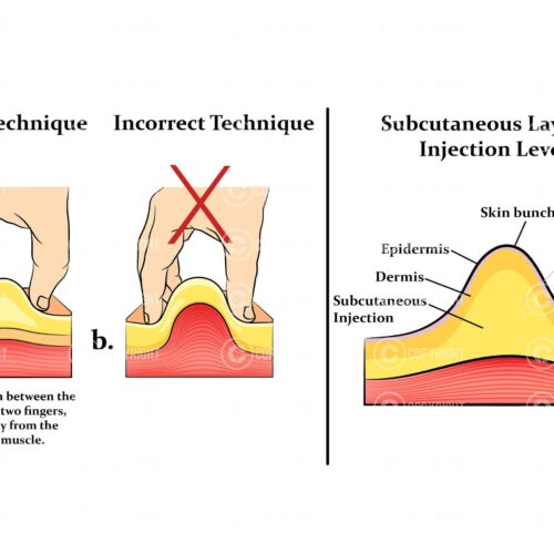 Subcutaneous injection technique Digital Download