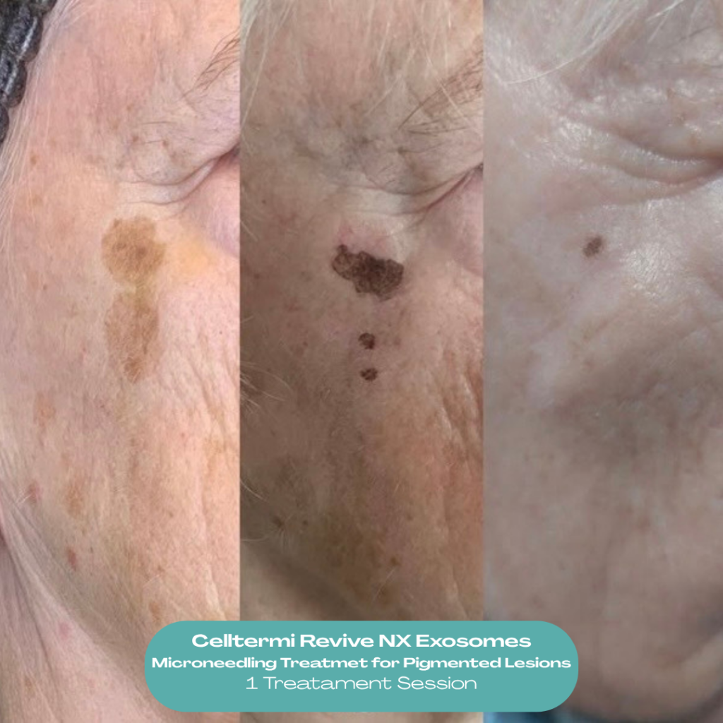 Before and after results showing improvement in a benign pigmented lesion following Celltermi Revive NX Exosome microneedling treatment by Nita McEvoy in Enfield, North London.
