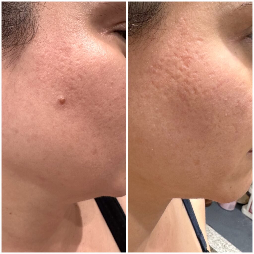 Before and fully healed cosmetic benign mole removal result in Enfield, North London.