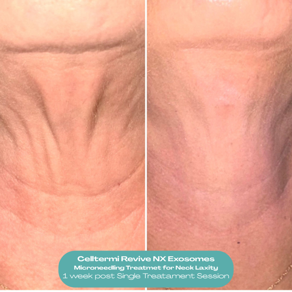 Before and after results showing improvement in neck skin laxity and crepey skin following professional microneedling with Celltermi Revive NX Exosomes by Nita McEvoy in Enfield, North London.