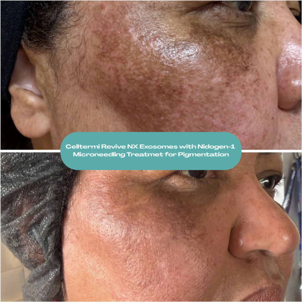 Before and after results showing improvement in facial pigmentation following professional microneedling with Celltermi Revive NX Exosomes by Nita McEvoy in Enfield, North London.