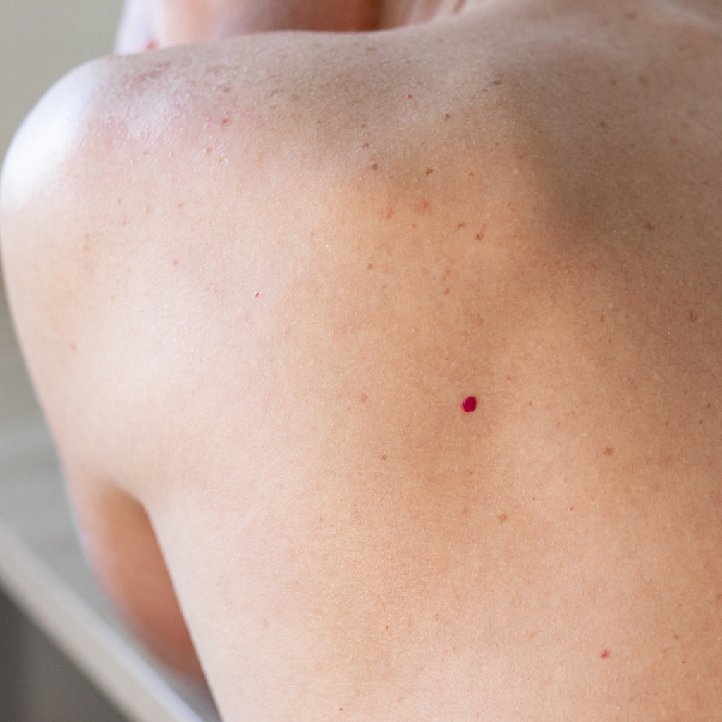 Cherry angioma on the back before cosmetic removal in Enfield, North London.