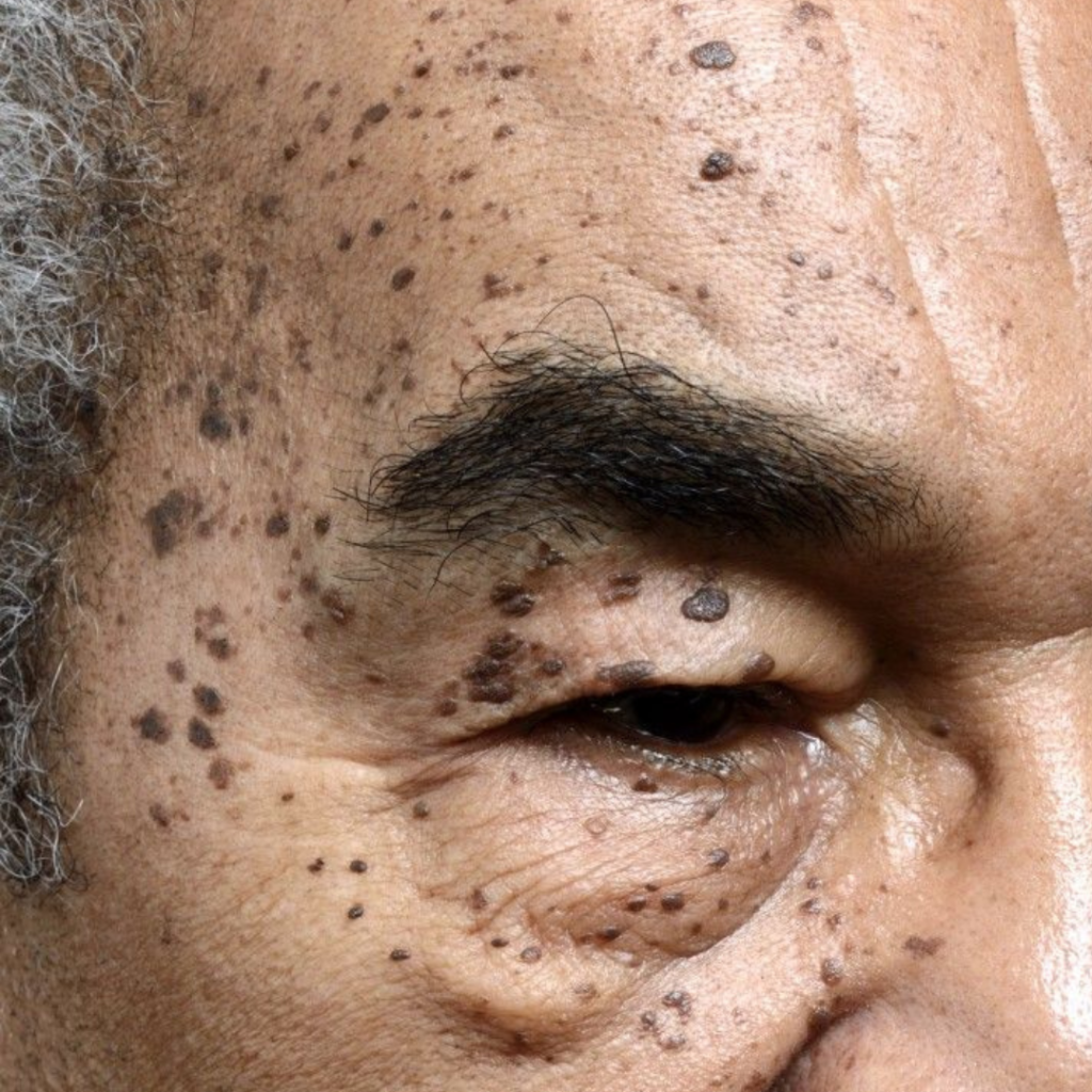Dermatosis Papulosa Nigra (DPN) before cosmetic removal using advanced electrolysis in Enfield, North London.