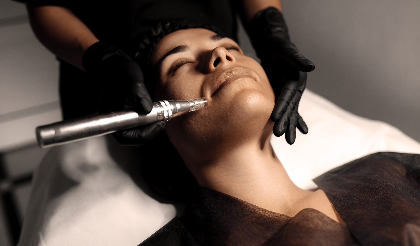 Professional microneedling treatment performed with Celltermi Revive NX Exosomes to improve acne scars, fine lines, pigmentation, enlarged pores and overall skin quality at Nita McEvoy Beauty & Regenerative Aesthetics in Enfield, North London.