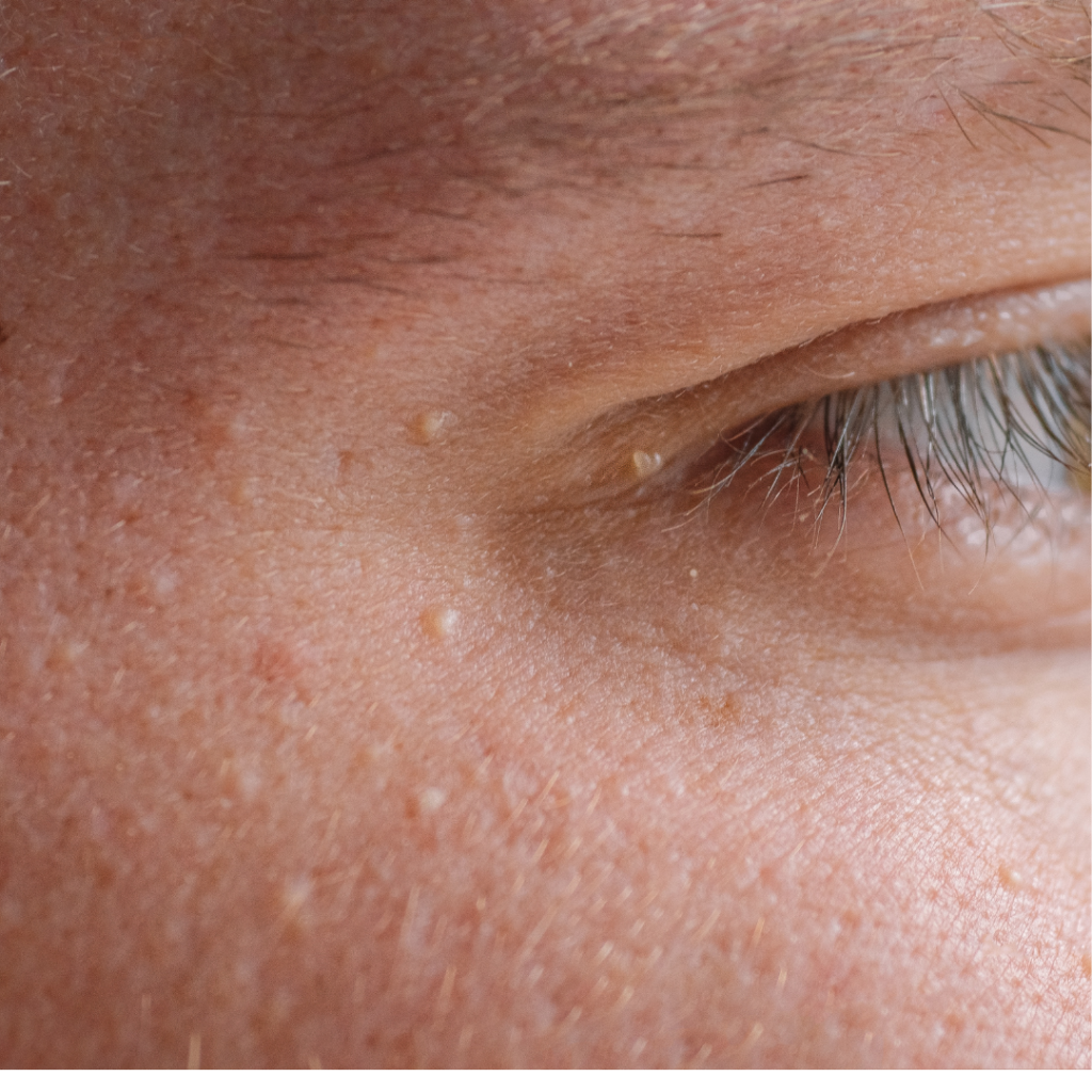 Milia around the eye before cosmetic milia removal treatment in Enfield, North London.