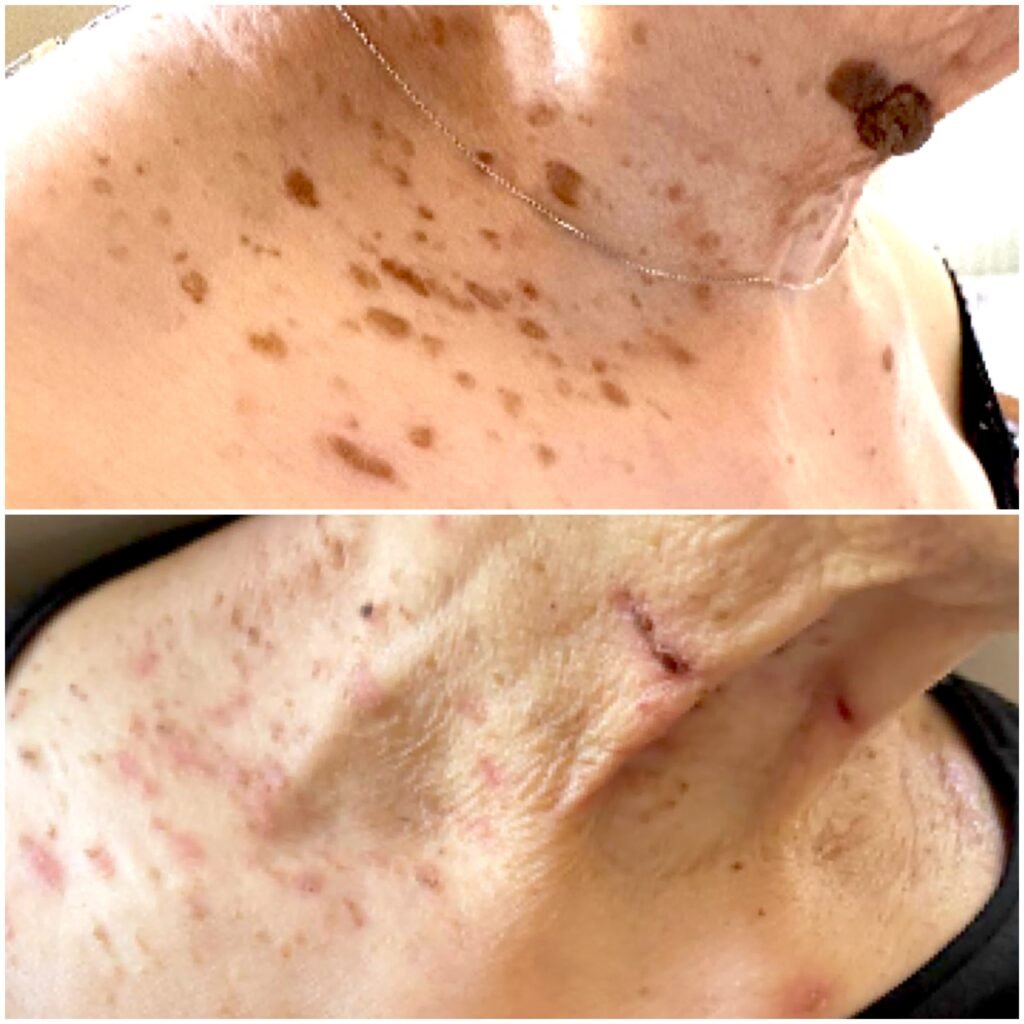 Before and healing stage after seborrhoeic keratosis removal using advanced electrolysis in Enfield, North London.