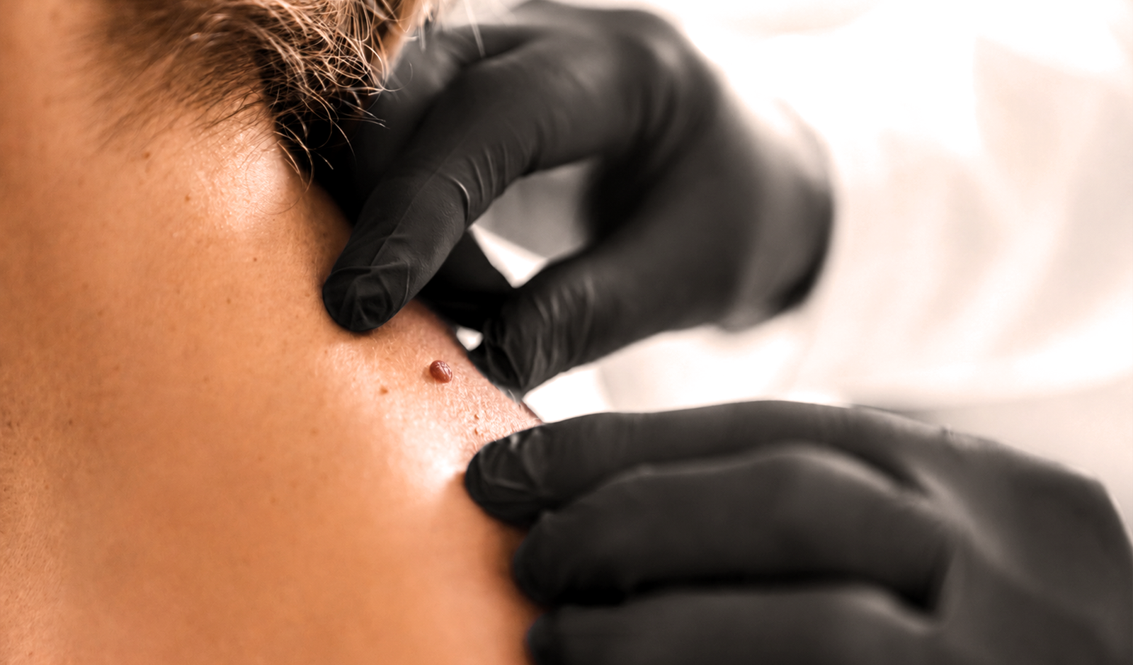 Cosmetic skin tag removal consultation using advanced electrolysis in Enfield, North London.