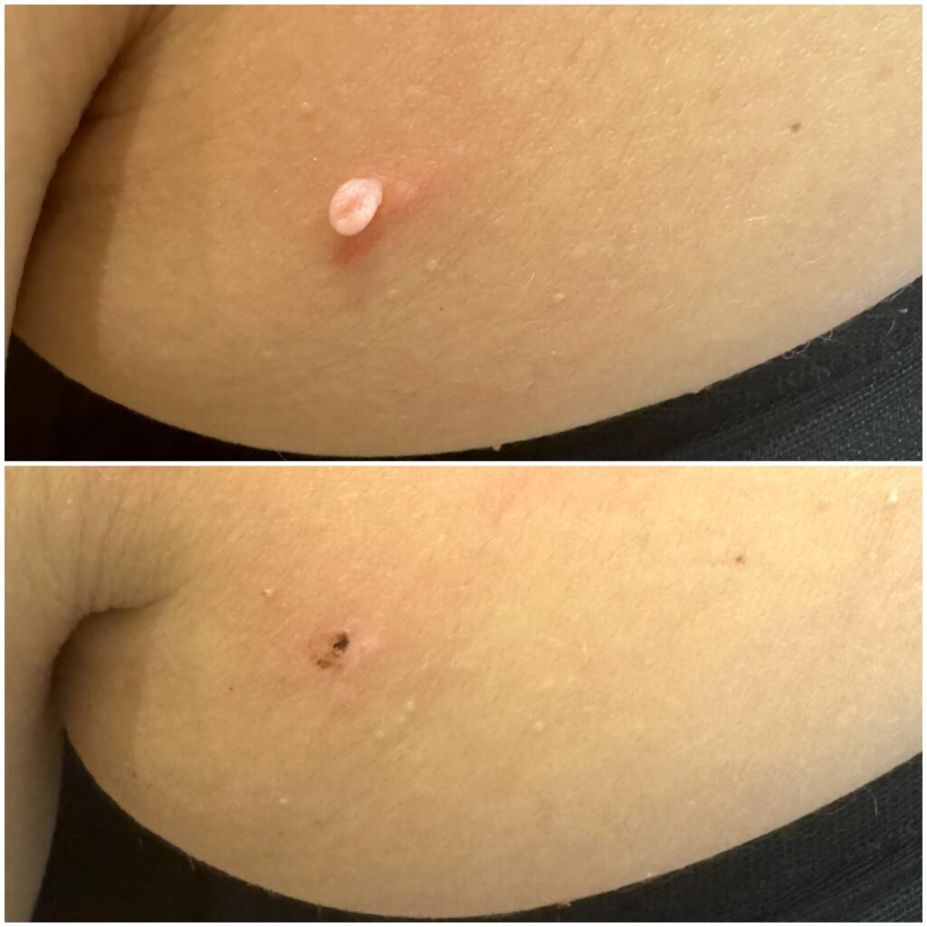 Before and after advanced electrolysis skin tag removal in Enfield, North London.